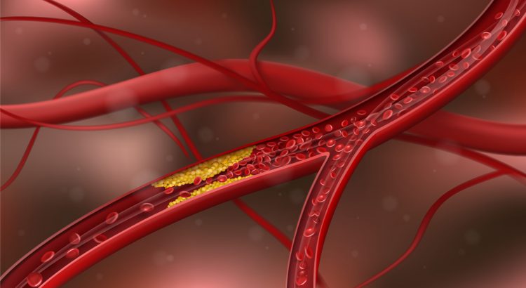 colesterol e doenças cardiovasculares